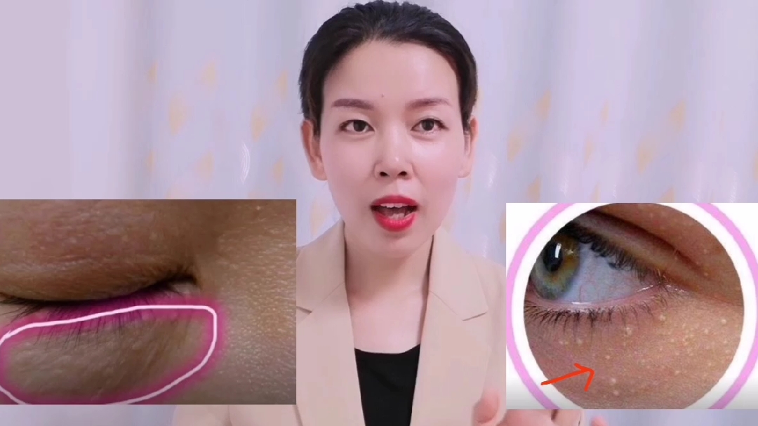 眼部长了脂肪粒或扁平疣怎么办?两个方法可消除不复发