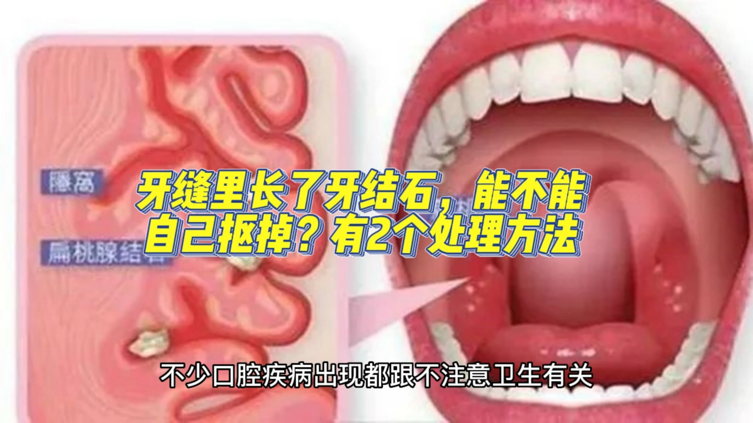 牙缝里长了牙结石,能不能自己抠掉?有2个处理方法