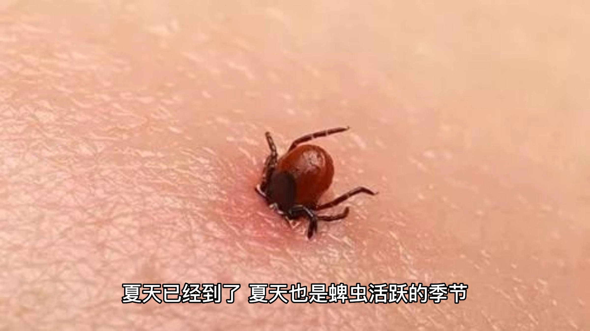 老太被蜱虫叮咬去世 四名亲属感染危及生命