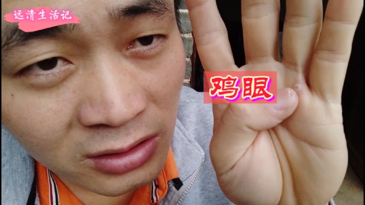20多天过去了,看看鸡眼恢复的怎么样了?